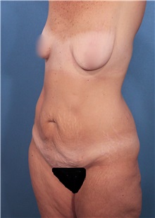 Tummy Tuck Before Photo by Marvin Shienbaum, MD; Brandon, FL - Case 30494