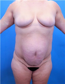 Tummy Tuck Before Photo by Marvin Shienbaum, MD; Brandon, FL - Case 30495