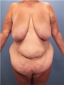 Tummy Tuck Before Photo by Marvin Shienbaum, MD; Brandon, FL - Case 30496