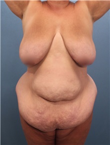 Tummy Tuck Before Photo by Marvin Shienbaum, MD; Brandon, FL - Case 30496