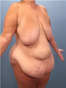 Tummy Tuck Before Photo by Marvin Shienbaum, MD; Brandon, FL - Case 30496