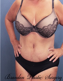 Tummy Tuck After Photo by Marvin Shienbaum, MD; Brandon, FL - Case 30496