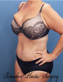 Tummy Tuck After Photo by Marvin Shienbaum, MD; Brandon, FL - Case 30496