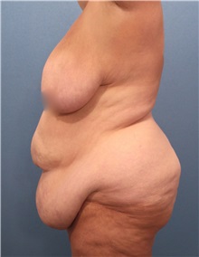 Tummy Tuck Before Photo by Marvin Shienbaum, MD; Brandon, FL - Case 30496