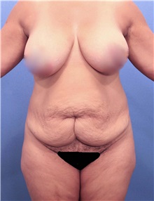 Tummy Tuck Before Photo by Marvin Shienbaum, MD; Brandon, FL - Case 30498