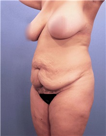 Tummy Tuck Before Photo by Marvin Shienbaum, MD; Brandon, FL - Case 30498