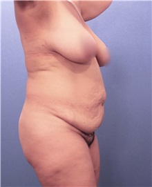 Tummy Tuck Before Photo by Marvin Shienbaum, MD; Brandon, FL - Case 30498