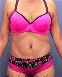 Tummy Tuck After Photo by Marvin Shienbaum, MD; Brandon, FL - Case 30499