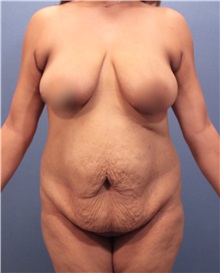 Tummy Tuck Before Photo by Marvin Shienbaum, MD; Brandon, FL - Case 30499