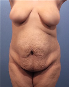 Tummy Tuck Before Photo by Marvin Shienbaum, MD; Brandon, FL - Case 30499