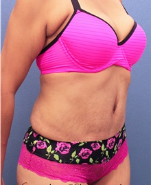 Tummy Tuck After Photo by Marvin Shienbaum, MD; Brandon, FL - Case 30499