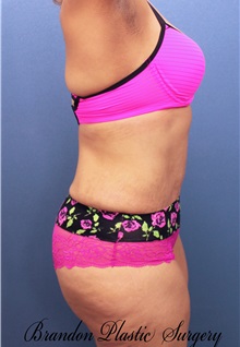 Tummy Tuck After Photo by Marvin Shienbaum, MD; Brandon, FL - Case 30499