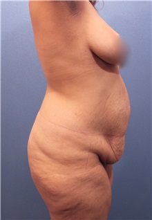 Tummy Tuck Before Photo by Marvin Shienbaum, MD; Brandon, FL - Case 30499