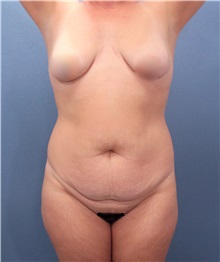 Tummy Tuck Before Photo by Marvin Shienbaum, MD; Brandon, FL - Case 30500