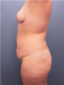 Tummy Tuck Before Photo by Marvin Shienbaum, MD; Brandon, FL - Case 30500