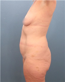 Tummy Tuck Before Photo by Marvin Shienbaum, MD; Brandon, FL - Case 30501