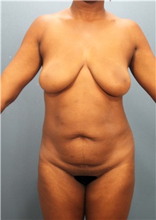 Tummy Tuck Before Photo by Marvin Shienbaum, MD; Brandon, FL - Case 30502