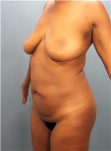 Tummy Tuck Before Photo by Marvin Shienbaum, MD; Brandon, FL - Case 30502