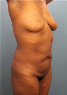 Tummy Tuck Before Photo by Marvin Shienbaum, MD; Brandon, FL - Case 30502