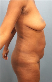 Tummy Tuck Before Photo by Marvin Shienbaum, MD; Brandon, FL - Case 30502