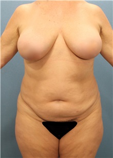 Tummy Tuck Before Photo by Marvin Shienbaum, MD; Brandon, FL - Case 30503