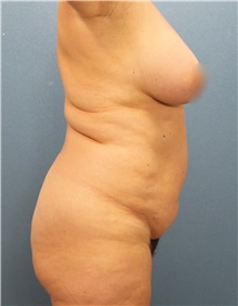 Tummy Tuck Before Photo by Marvin Shienbaum, MD; Brandon, FL - Case 30503