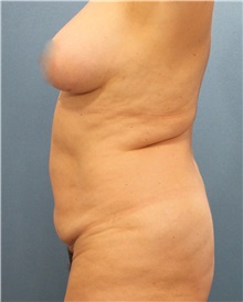 Tummy Tuck Before Photo by Marvin Shienbaum, MD; Brandon, FL - Case 30503