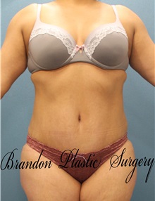 Tummy Tuck After Photo by Marvin Shienbaum, MD; Brandon, FL - Case 30504