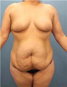 Tummy Tuck Before Photo by Marvin Shienbaum, MD; Brandon, FL - Case 30504