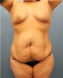 Tummy Tuck Before Photo by Marvin Shienbaum, MD; Brandon, FL - Case 30504