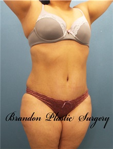 Tummy Tuck After Photo by Marvin Shienbaum, MD; Brandon, FL - Case 30504