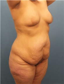 Tummy Tuck Before Photo by Marvin Shienbaum, MD; Brandon, FL - Case 30504