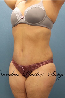 Tummy Tuck After Photo by Marvin Shienbaum, MD; Brandon, FL - Case 30504