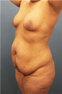 Tummy Tuck Before Photo by Marvin Shienbaum, MD; Brandon, FL - Case 30504