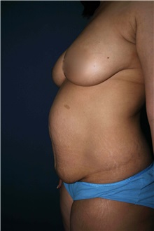Tummy Tuck Before Photo by Marvin Shienbaum, MD; Brandon, FL - Case 30523