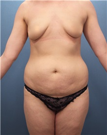 Tummy Tuck Before Photo by Marvin Shienbaum, MD; Brandon, FL - Case 30524