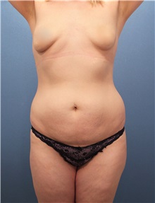 Tummy Tuck Before Photo by Marvin Shienbaum, MD; Brandon, FL - Case 30524