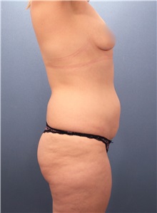 Tummy Tuck Before Photo by Marvin Shienbaum, MD; Brandon, FL - Case 30524