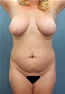 Tummy Tuck Before Photo by Marvin Shienbaum, MD; Brandon, FL - Case 30525