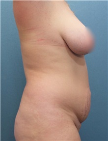 Tummy Tuck Before Photo by Marvin Shienbaum, MD; Brandon, FL - Case 30525