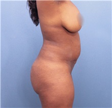 Tummy Tuck Before Photo by Marvin Shienbaum, MD; Brandon, FL - Case 30526