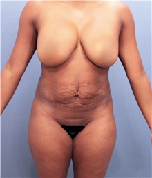 Tummy Tuck Before Photo by Marvin Shienbaum, MD; Brandon, FL - Case 30526