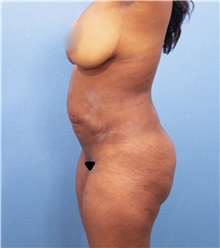 Tummy Tuck Before Photo by Marvin Shienbaum, MD; Brandon, FL - Case 30526