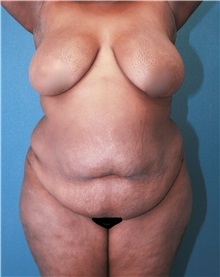 Tummy Tuck Before Photo by Marvin Shienbaum, MD; Brandon, FL - Case 30527