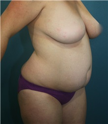 Tummy Tuck Before Photo by Marvin Shienbaum, MD; Brandon, FL - Case 30529