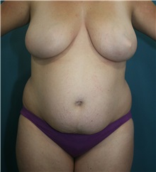 Tummy Tuck Before Photo by Marvin Shienbaum, MD; Brandon, FL - Case 30529