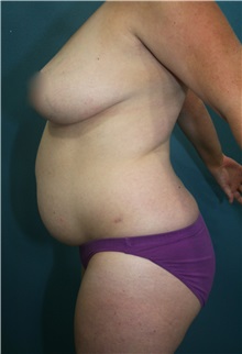 Tummy Tuck Before Photo by Marvin Shienbaum, MD; Brandon, FL - Case 30529