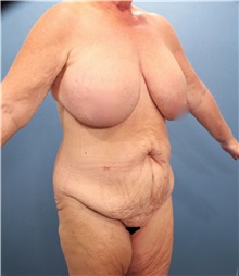 Tummy Tuck Before Photo by Marvin Shienbaum, MD; Brandon, FL - Case 30530