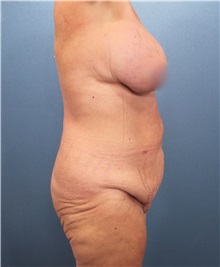 Tummy Tuck Before Photo by Marvin Shienbaum, MD; Brandon, FL - Case 30530