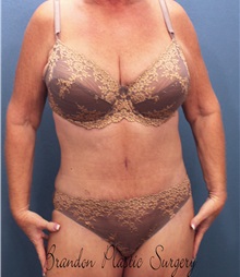 Tummy Tuck After Photo by Marvin Shienbaum, MD; Brandon, FL - Case 30530